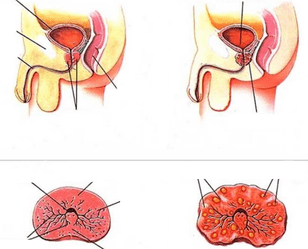 normale prostaat en chronische prostatitis