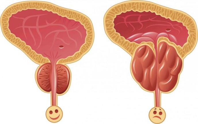 gezonde en ontstoken prostaat met prostatitis