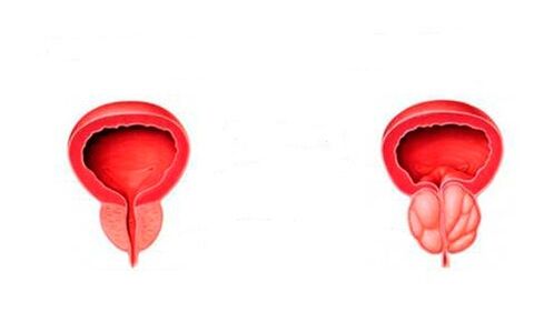 gezonde en ontstoken prostaat met prostatitis