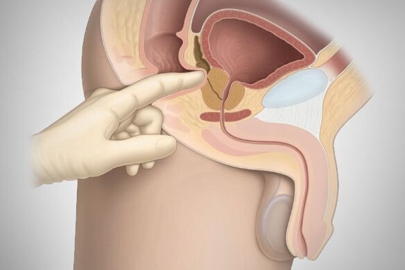 Prostaatmassage voor bacteriële prostatitis