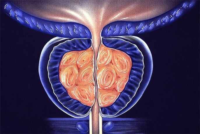 symptomen en behandeling van prostatitis