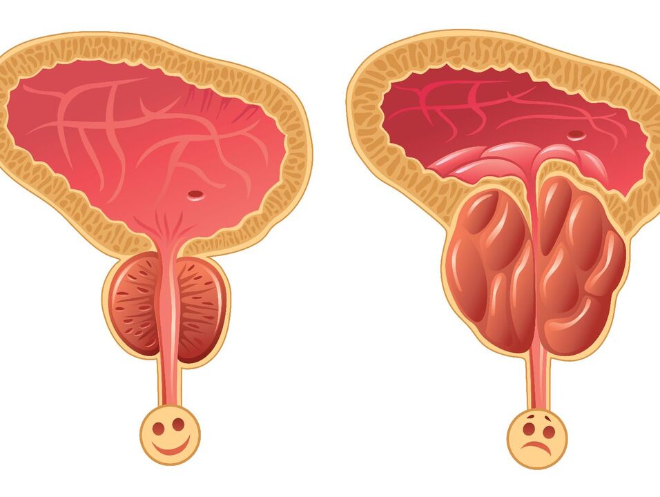 Gezonde prostaatklier en prostaatcongestie met congestieve prostatitis