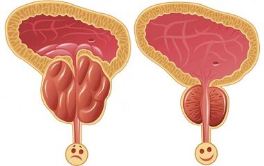 hoe Prostalix werkt bij prostatitis voor en na de behandeling
